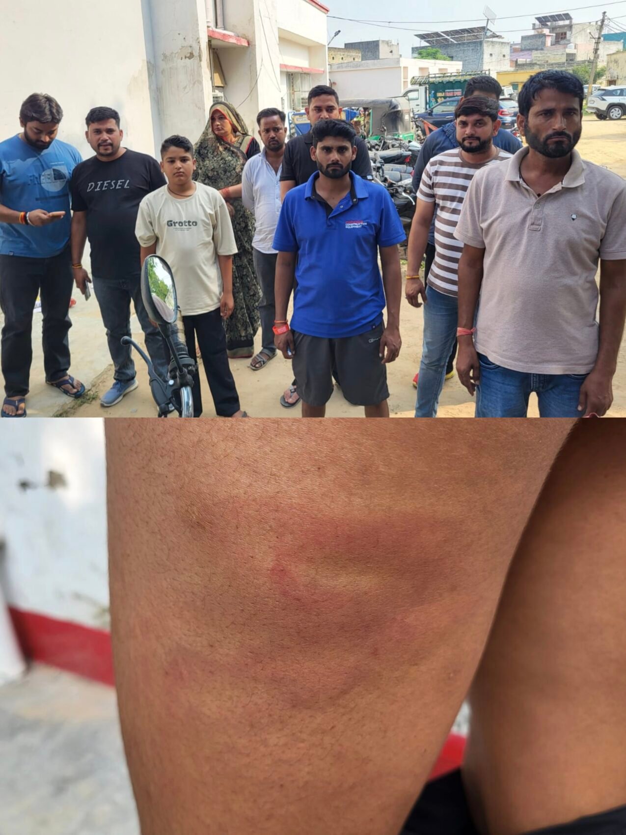 खुर्जा में शिक्षक की बेरहमी: मदर एकेडमी में पढ़ने वाले सातवीं के छात्र को बुरी तरह पीटा, शरीर पर बने नीले निशान